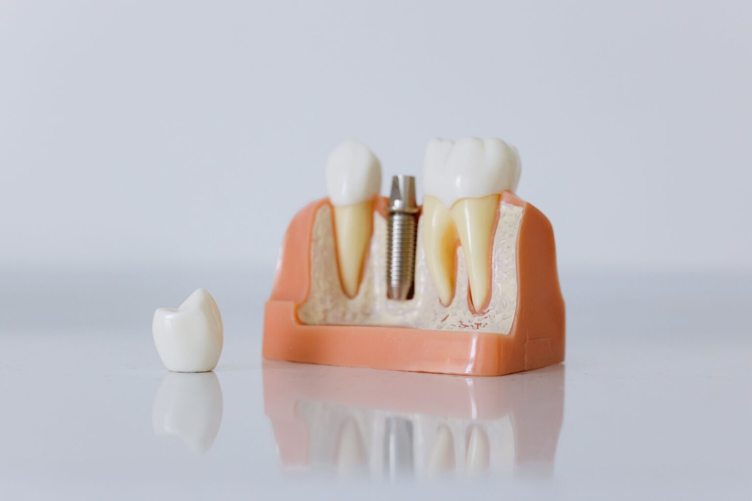 The Growing Appeal of Dental Implants: What Patients Should Know